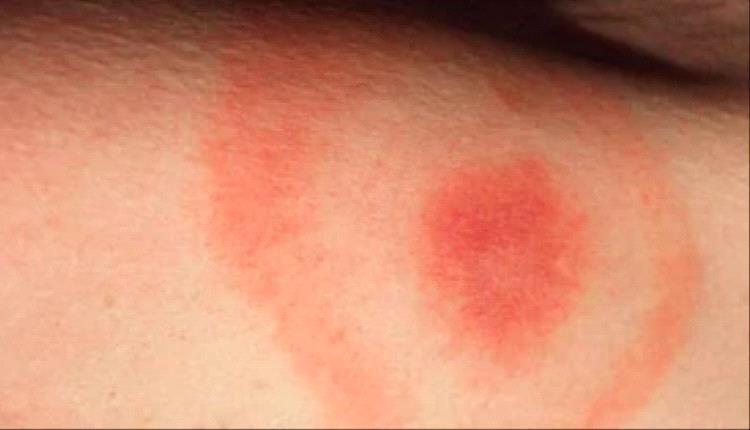 5 أعراض لسرطان الدم تظهر على الجلد