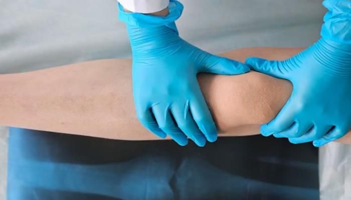 بسبب طولها.. سيدة تخضع لجراحة تقصير الساقين في تركيا