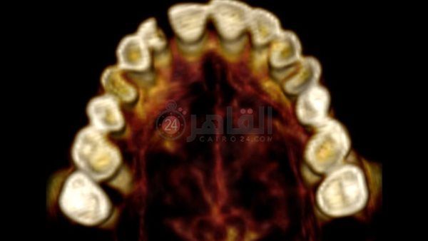 جراح أسنان: علامات بالفم قد تكشف عن مخاطر أمراض القلب