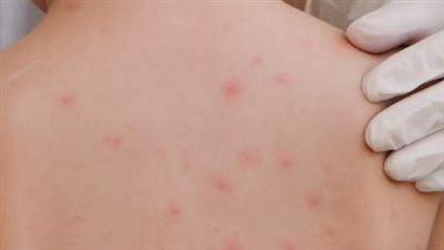 عاجل | 4 حالات فقط.. تعليم الجيزة توضح حقيقة ظهور أعراض جلدية بين الطلاب بالمدارس - الخليج الان