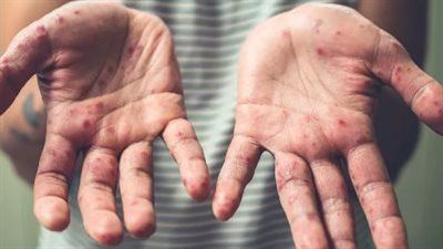 المتحدث باسم وزارة الصحة والسكان يكشف تفاصيل انتشار HFMD في مدرسة بالجيزة - الخليج الان