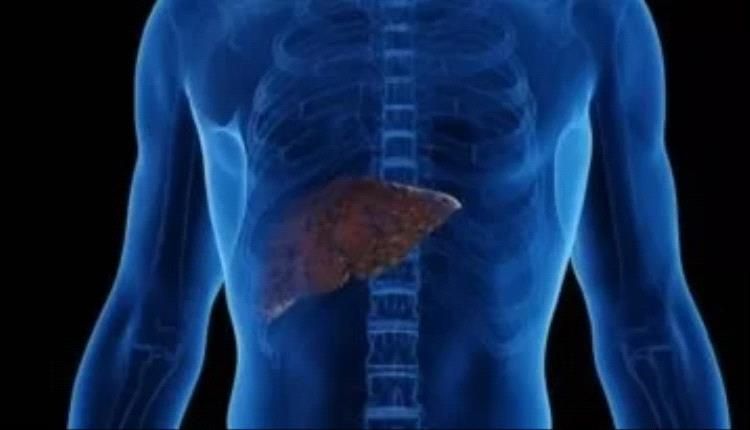 تحذيرات طبية: 3 عوامل خطيرة تهدد الكبد وتزيد من الوفيات