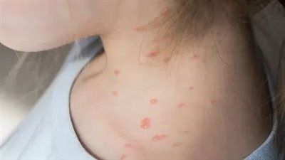 إصابة 12 تلميذ بالجدري المائي وتعليم المنوفية يؤكد: "تم نقلهم إلى الوحدة الصحية" - الخليج الان