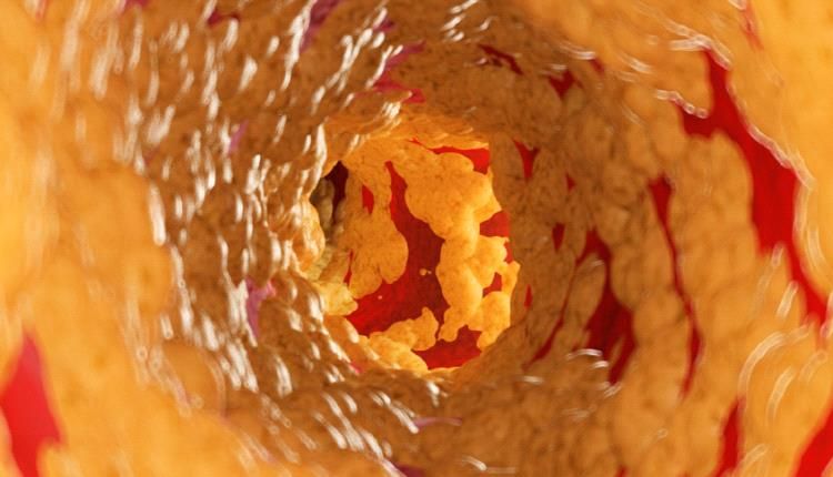 دهون مدمرة خفية لدى النحفاء !