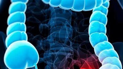 قبل سن الخمسين..احذر هذه الأمراض المزمنة قد ترفع خطر الإصابة بسرطان القولون بنسبة 600% - الخليج الان