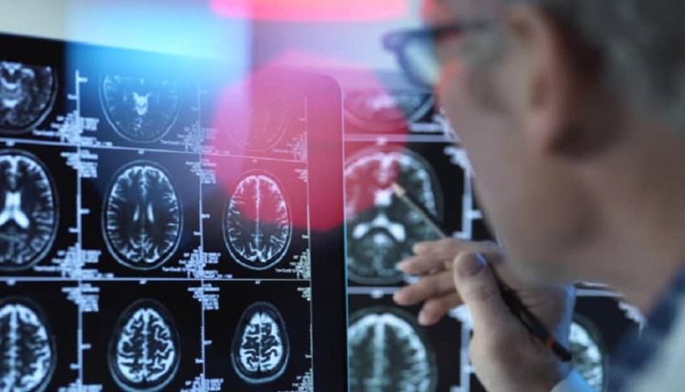 اكتشاف علمي..."الفياغرا" لعلاج الزهايمر !