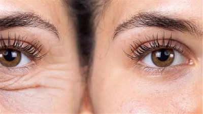 تجاعيد العين تفسد نضارة وجهك.. 4 وصفات طبيعية لاستعادة إشراقة بشرتك - الخليج الان