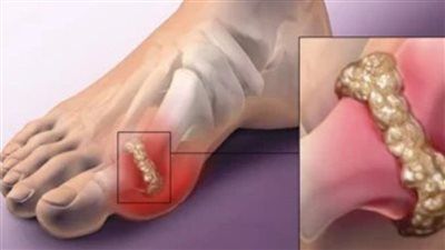 قبل أن يشتد الألم.. أطعمة طبيعية قد تساعد في تقليل نوبات النقرس - الخليج الان