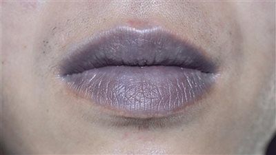 سواد الشفايف.. أسباب خفية وحلول آمنة لاستعادة اللون الطبيعي - الخليج الان