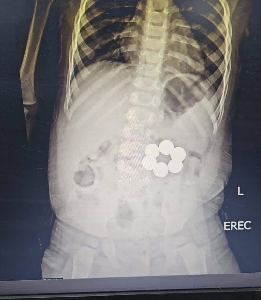 إنقاذ رضيع ابتلع 6 قطع مغناطيس في جراحة دقيقة بمستشفى الأطفال الجامعي بالمنصورة - الخليج الان
