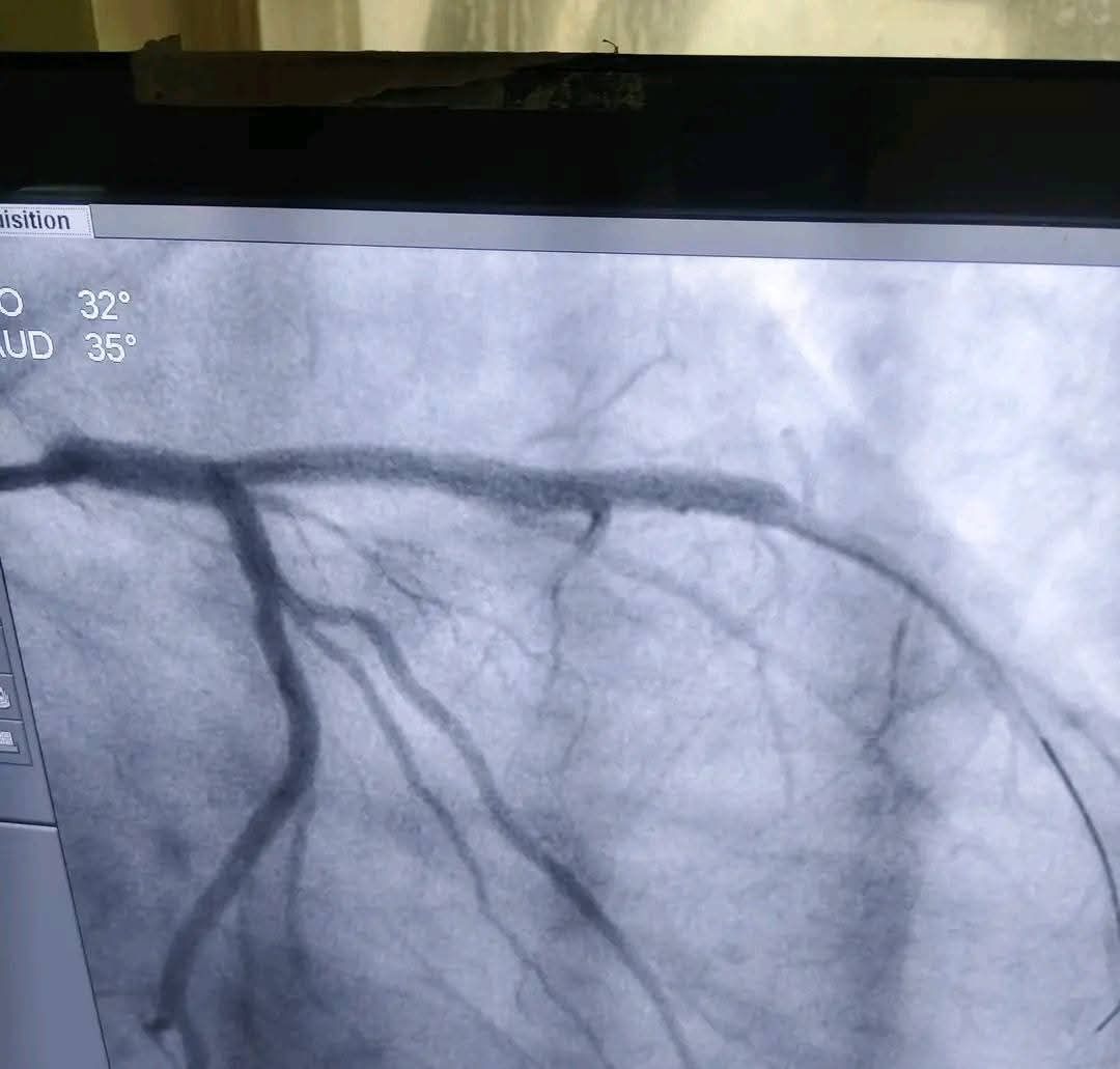 مستشفيات جامعة الفيوم تنجح في إنقاذ مريض بجلطة تاجية حادة خلال أقل من 20 دقيقة - الخليج الان