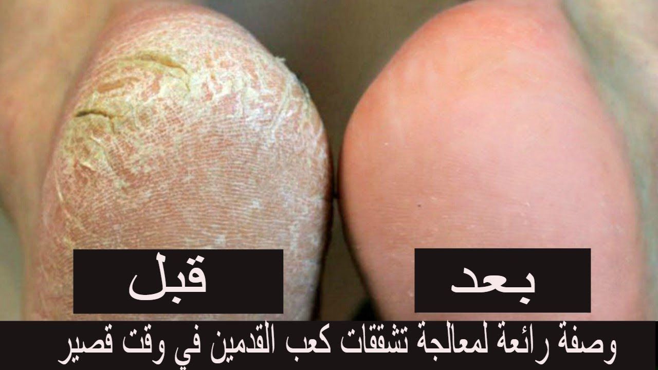 وصفة سحرية للتخلص على تشققات القدمين العنيدة في أقل من أسبوع
