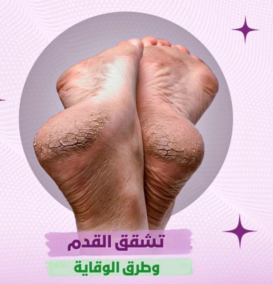 وصفة سحرية للتخلص على تشققات القدمين العنيدة في أقل من أسبوع