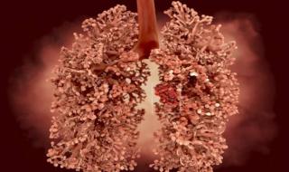 خطورة التعرض للإصابة بسرطان الرئة !